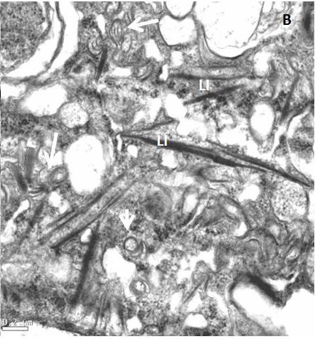 <p><b><p>Secções ultra-finas mostrando inclusões lamelares (LI) e alguns cata-ventos (“pinheels”) típicos de infecção causada por <em>Potyvirus</em>.</p>
<p></p></b></p><p>Autor: E.W. Kitajima</p>